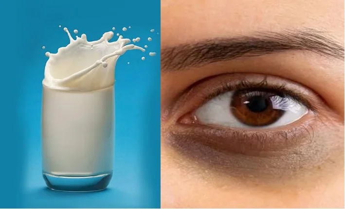 Dark Circles: क्या आंखों के नीचे cold milk लगाने से दूर होंगे dark circles? जानिए कितना सच, कितना फसाना